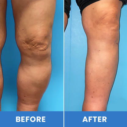 LIMETOW® Lymphatic Drainage Oil Spray