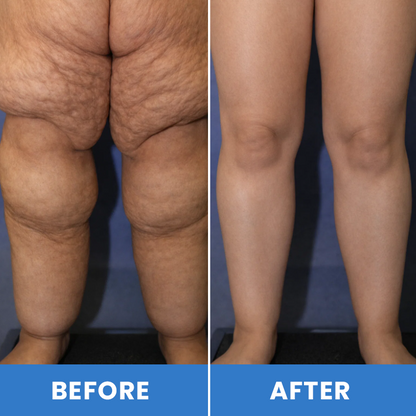 LIMETOW® Lymphatic Drainage Oil Spray