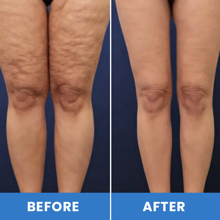 LIMETOW® Lymphatic Drainage Oil Spray